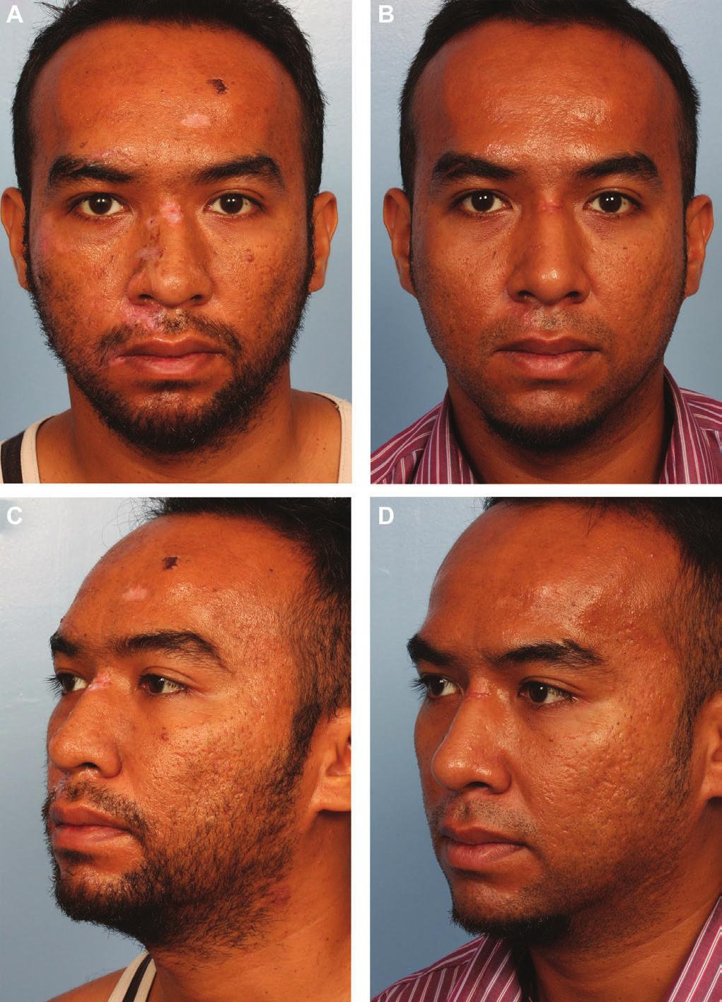 508 Aesthetic Surgery Journal 33(4) Figure 3. (A, C, E) This 34-year-old man was involved in a traffic accident.
