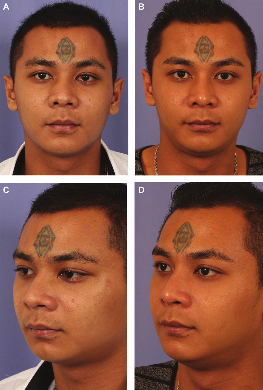 510 Aesthetic Surgery Journal 33(4) Figure 4. (A, C, E) This 21-year-old man was assaulted and sustained a nasal facture and deviation causing a blocked airway.