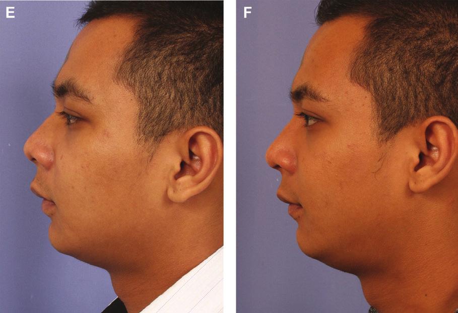 Wong and Daniel 511 Figure 4.(continued) (A, C, E) This 21-year-old man was assaulted and sustained a nasal facture and deviation causing a blocked airway.