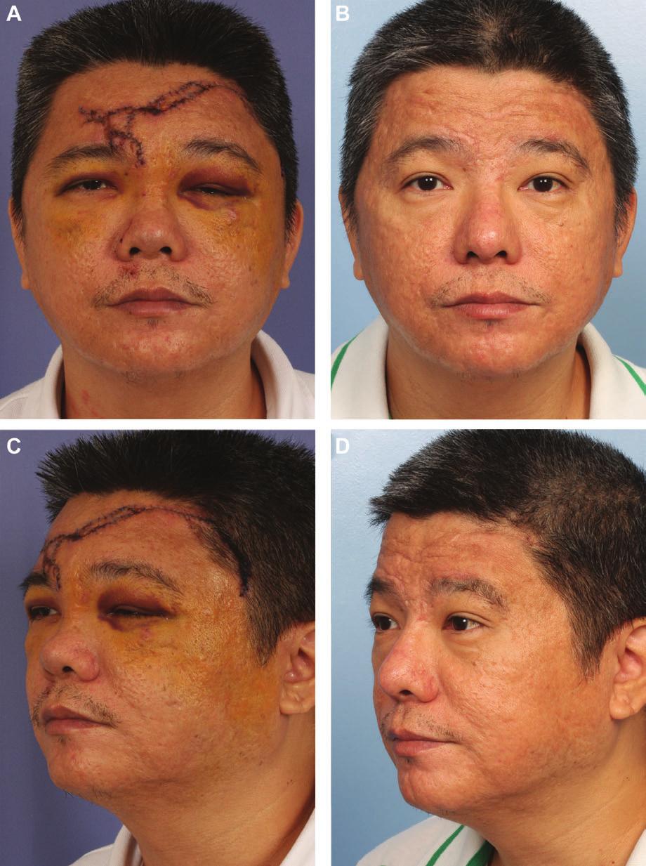 512 Aesthetic Surgery Journal 33(4) Figure 5. (A, C, E) This 40-year-old man was involved in a traffic accident.