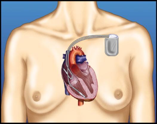 Implantable Cardioverter