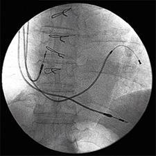 Cardiac Resynchronization (BiV, Biventricular pacing) Cardiac Resynchronization Over a third of moderate to severe heart failure