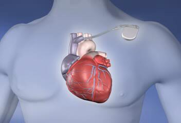 About an ICD if: A prior cardiac arrest Ventricular tachycardia (VT) Ventricular