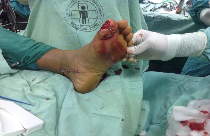 Soft tissue reconstruction of the distal lower leg and foot: are free flaps the only choice? Review of 25 cases. J Pl, Reconstr & Aesth Surg.