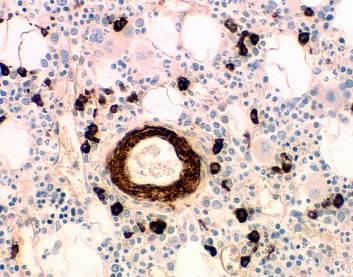 P04 Non Biopsy Other This category encompasses a wide variety of sample types including but not limited to skin lesion excisions, placentas, lymph node biopsies and bone marrow biopsies.