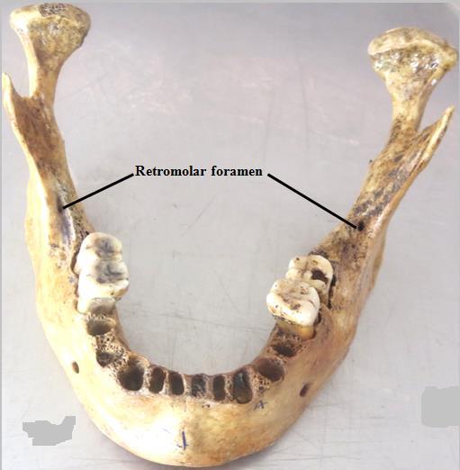 connection with the third molar, this is the so-called Chompret-L Hirondel abscess.