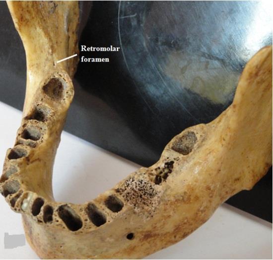 wisdom teeth. The mean diameter of the foramen was 1.38 mm (range- 1.10-1.92 mm).