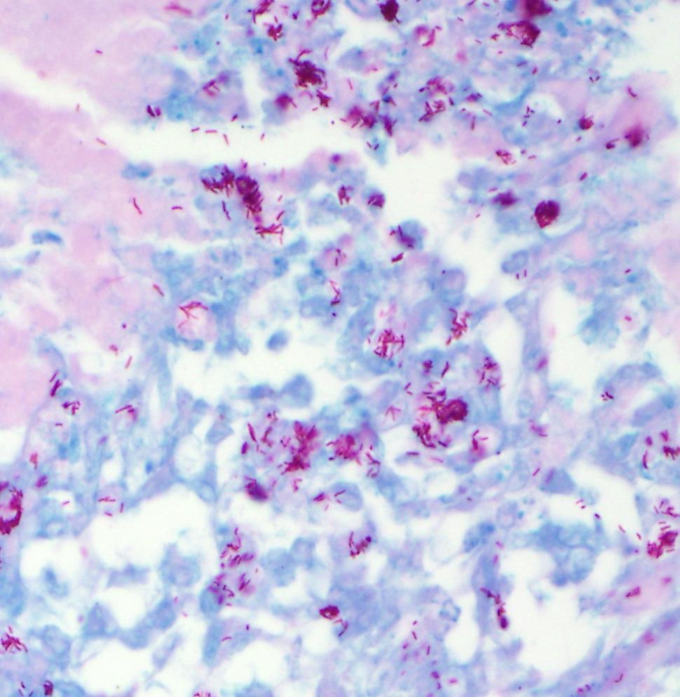 Spleen Acid-fast stain Etiology and Disease Name