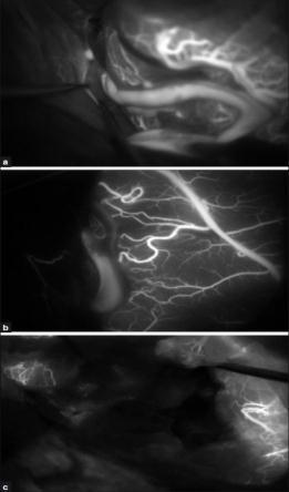 ICG imaging Indocyanine Green ICG Post-operative Management Hemodynamic control is the primary goal of postoperative management.