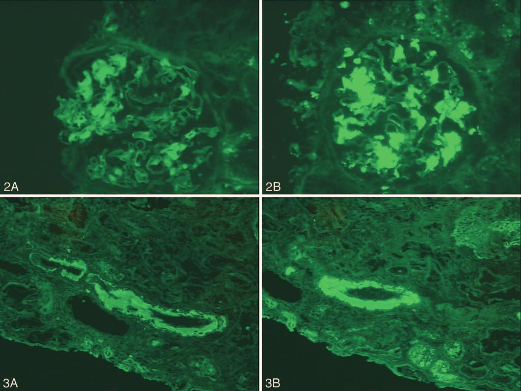 Figure 2. Direct immunofluorescence staining for and light chains in AL (amyloid light chain) amyloidosis.