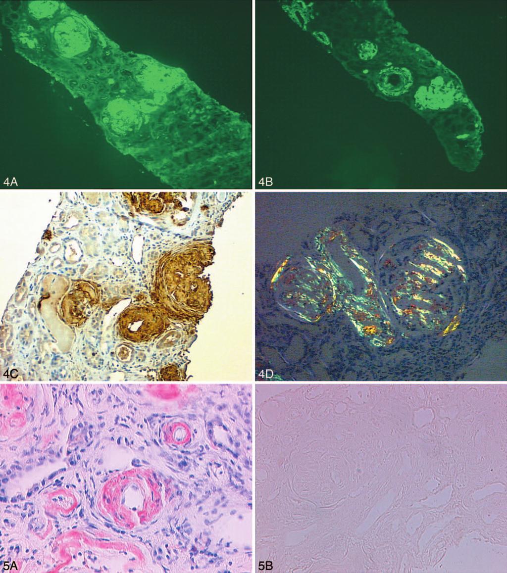 Figure 4. Case of AA (amyloid A) amyloidosis with nonspecific light-chain staining. A, 3 light-chain staining (immunofluorescence, original magnification 100).