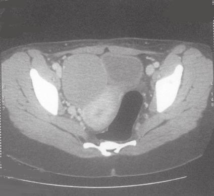 Slimane et al. 75 CASE REPORT A 32-year-old female presented with a family history of PJS. The patient presented in 2011 an adnexal mass.
