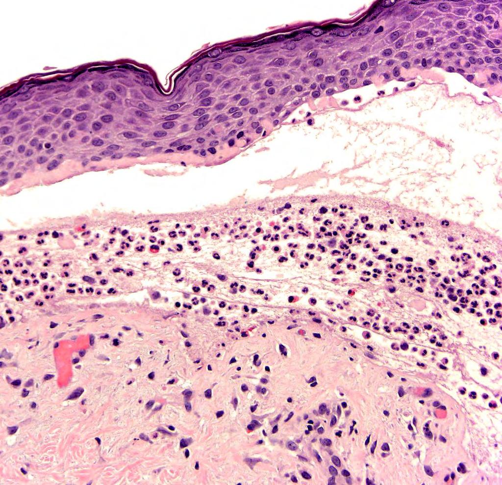 Neutrophilic BP Predominance of neutrophils Rare eosinophils Histologic DDx: Dermatitis