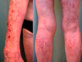 Anti-p200 Pemphigoid Slightly younger age of onset than BP