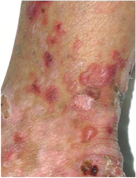 LPP: Clinical Lichen planus Violaceous flat-topped papules White reticulated oral