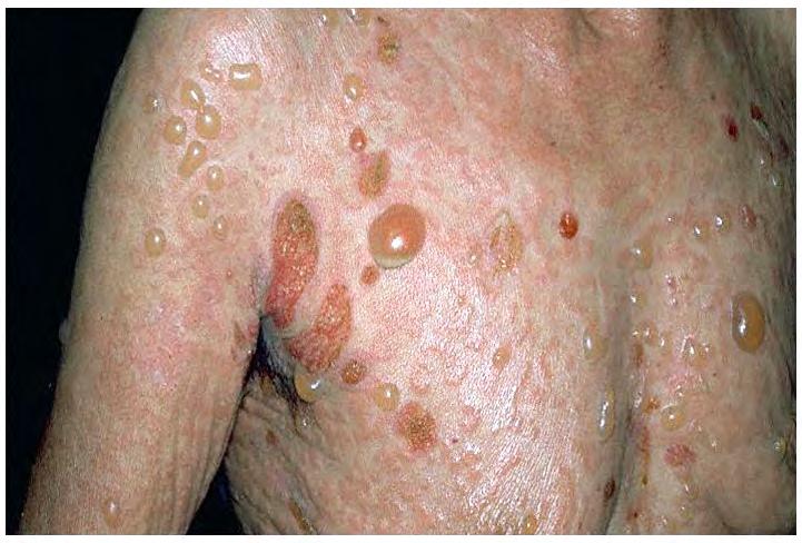 Bullous Pemphigoid (BP) Most common blistering disease Elderly (7 th decade) May be induced by UV light, drugs, vaccines Severe