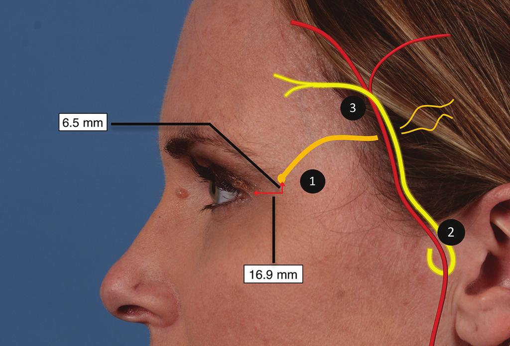 138 Current Perspectives on Less-known Aspects of Headache Figure 4. ART temporal trigger site injections.
