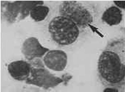 Chlamydial Inclusion Bodies Gram Negative Intracellular Diplococci Complications