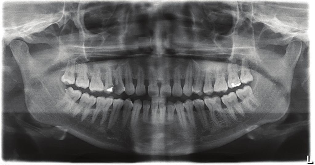 2 Case Reports in Dentistry Figure 1: OPG showing three rooted bilateral first premolar; mesiodistal root diameter was greater than the mesiodistal width of the crown.