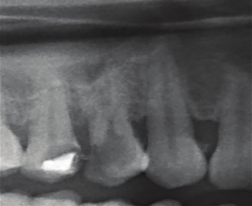 Case Reports in Dentistry 3 Preoperative 14 Postoperative 14 Preoperative 24 Postoperative 24 Figure 3: Preoperative and postoperative radiographs of 14 and 24 showing three roots.