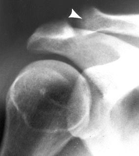 Osteolysis distal clavicle treatment