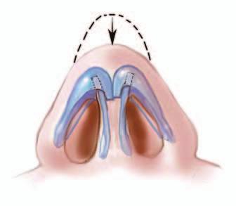 n external incision is used to expose the alar cartilages and nasal dorsum. The alar cartilages are then separated in the midline.
