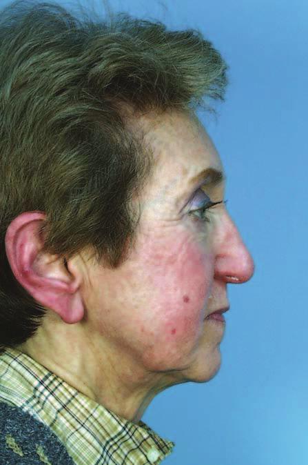ecause of the ptotic tip and the need to cephalically rotate the nose, 9 mm of lateral crural overlay were performed.