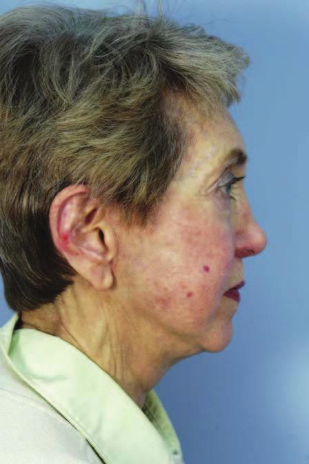 , Pretreatment view of a 72-year-old woman with an excessively ptotic nasal tip.