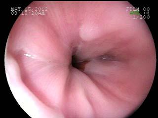 In the two patients presenting with food impaction, endoscopic findings were typical of Ee and EHPF was > 15.