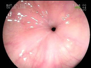 There were no complications following endoscopy and no adverse effects secondary to treatment.