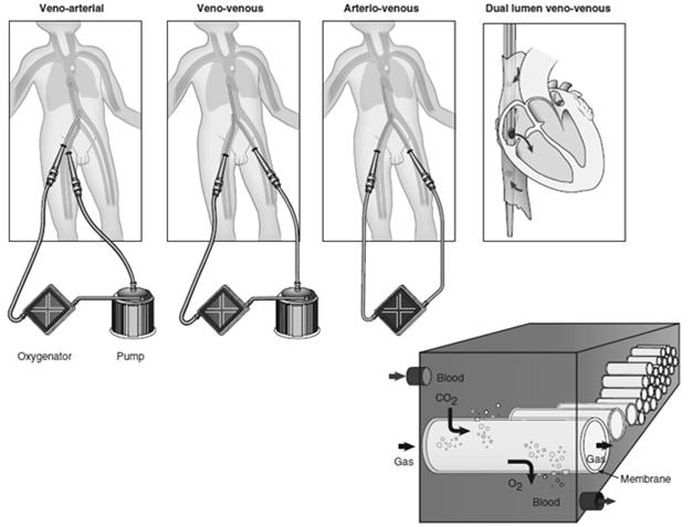 Does ECMO have a role in CPR?