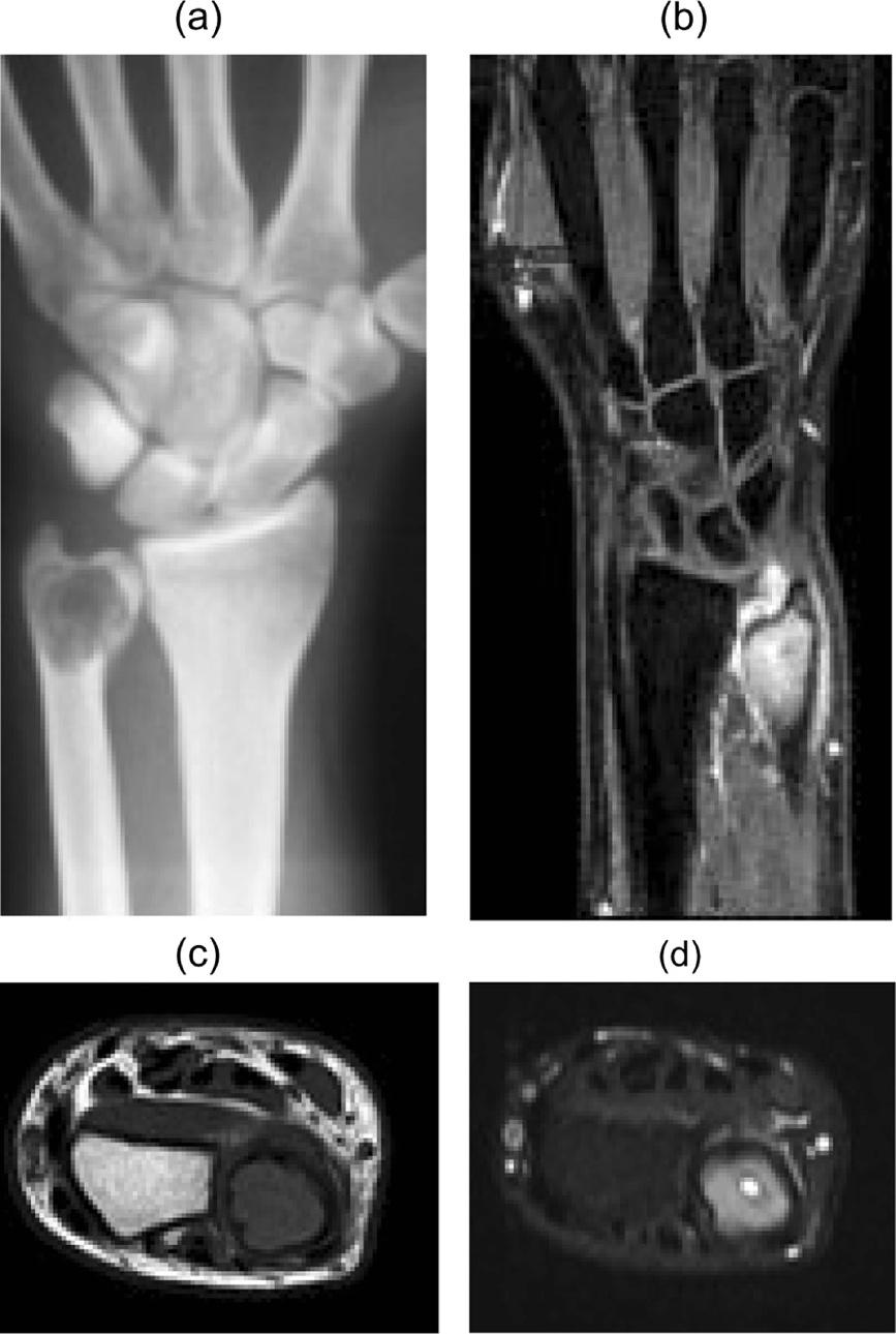 Vanni et al. Journal of Medical Case Reports 2012, 6:143 Page 2 of 5 Figure 1 X-rays and magnetic resonance imaging with and without contrast.
