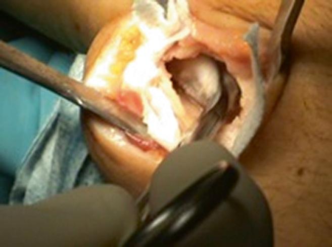 Currently, surgical treatments are: Intralesional curettage Curettage and bone grafting Cryotherapy of the cavity after curettage Application of phenol after curettage Radiation Insertion of methyl