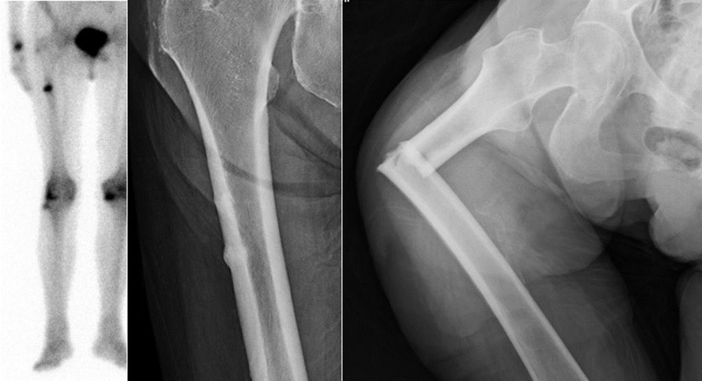 Atypical femoral fractures For every 137 hip fractures