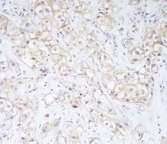 Anatomic Pathology / ORIGINAL ARTICLE Image 2 Membranous pattern of HER-2/neu protein overexpression ( 200). bodies.