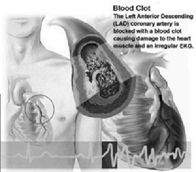 factors Ischemic heart disease