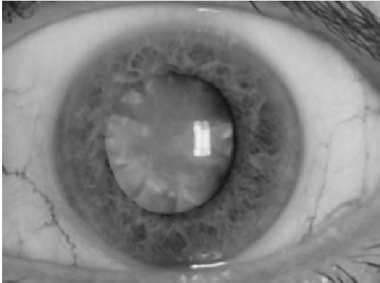 evidence of involvement in cataract formation is less strong DR is the leading cause of blindness in the working population of the Western world The prevalence increase with the duration of the