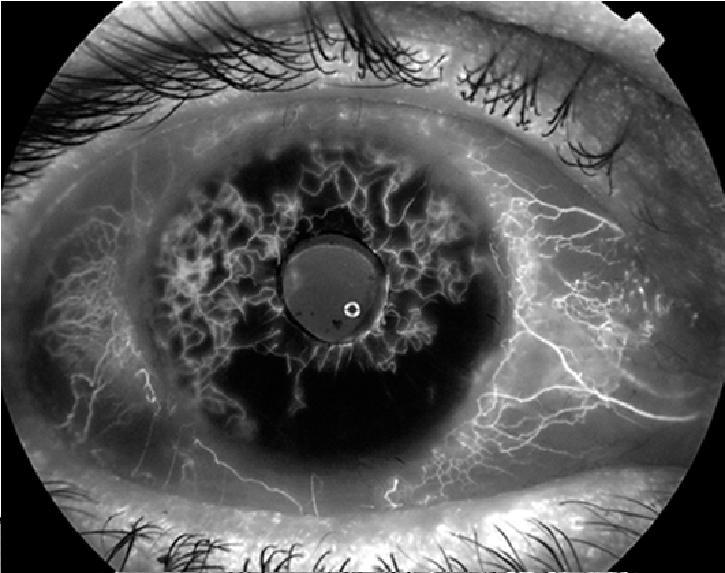 Severe non-proliferative/proliferative retinopathy Macular edema or exudates in close proximity to the macula