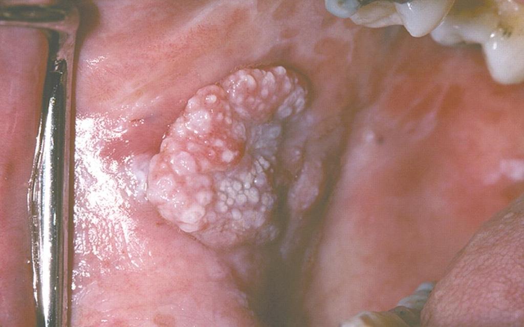 carcinoma From Neville, B. W.