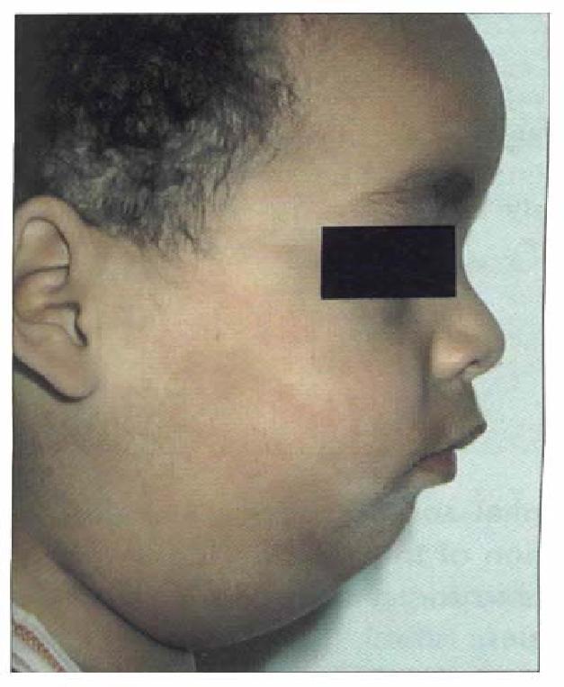 Mumps Epidemic parotitis; self-limited, associated with painful swelling of parotid salivary glands Humans are the