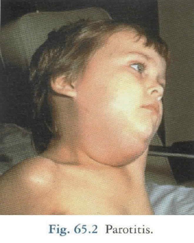 malaise, classic swelling of one or both cheeks Usually uncomplicated invasion of other organs; in 20-30% of