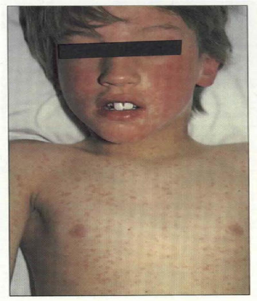 Measles Caused by Morbillivirus Also known as red measles Very contagious; transmitted by respiratory aerosols Humans are the only reservoir