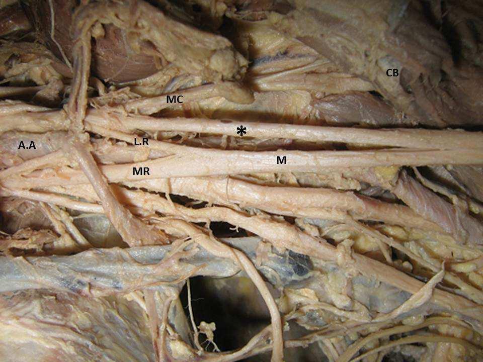 Figure 1. Photograph of the dissected left arm A.A: Axillary Artery; M.C: Musculocutaneous nerve; M.R: Medial root of median nerve; L.