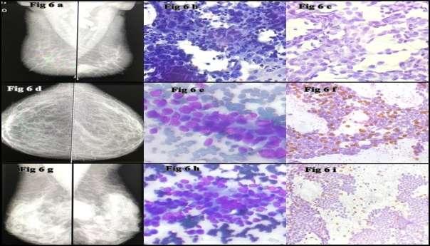 Table /Figure 6: 6a: BIRADS 5 Mammography, 6b: IDC, Pap stain 40X, 6c: p63 immunostain 40X zero % positivity.