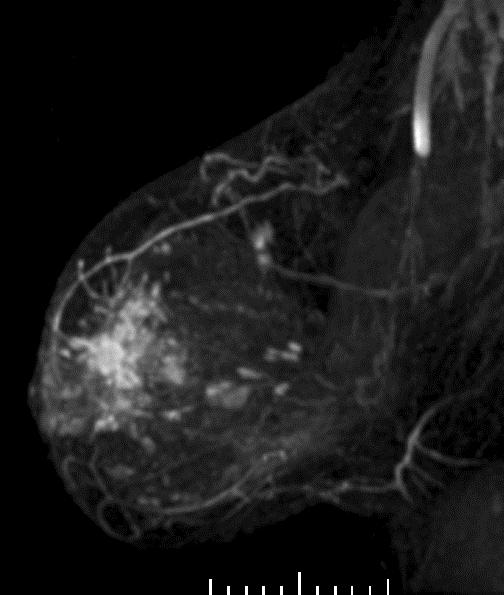 Impact of MRI on Ipsilateral Surgical Management Dense Breast Study