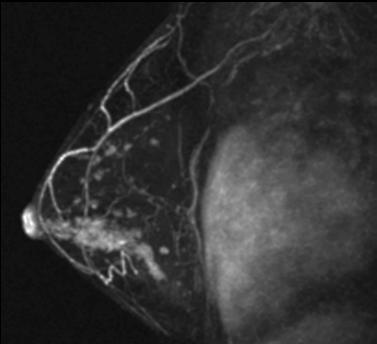visible on MRI Non high-grade disease Exclusion criteria: Suspicion of invasive cancer on core biopsy or MRI Palpable DCIS