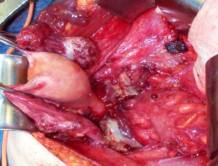 Resection of cul de sac