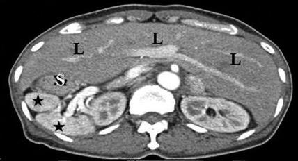 diaphragm (arrows), and hepatic shadow in the left side abnormally. A B C Fig. 5.