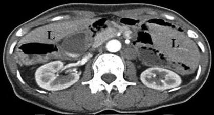 B: Multiple sandy stones in midline gallbladder.