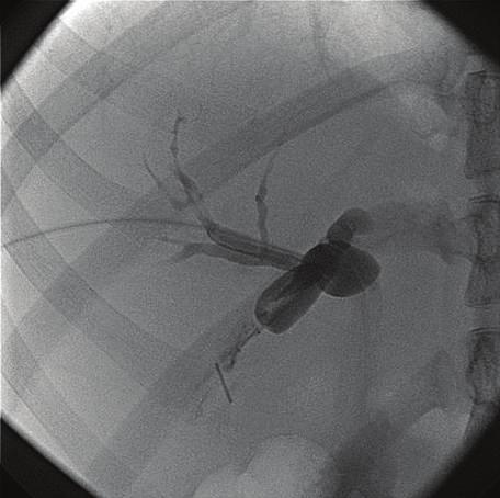 Cholangiogram : red arrow shows a diverticulum with end of cystic duct after cholecystectomy; white arrow shows CBD which is not filled yet with contrast.